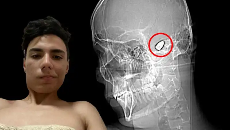 Kafasının İçinde Patlamaya Hazır Bomba: Hayatı Tehlikede Olan Genç Adamın İfadesi