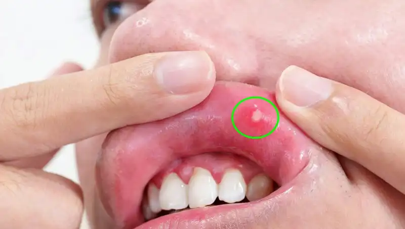 Kanserin İlk Uyarıları Göz Ardı Edildi: Dil Alımı Gerekli Oldu